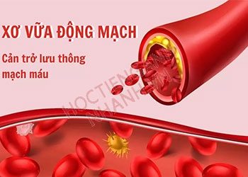 Xơ vữa động mạch tiếng Anh là gì? Học phát âm và cụm từ liên quan